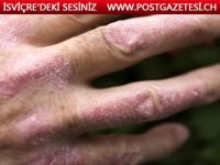 Sedef hastalığı yaşayanlara yardım için danışmanlık